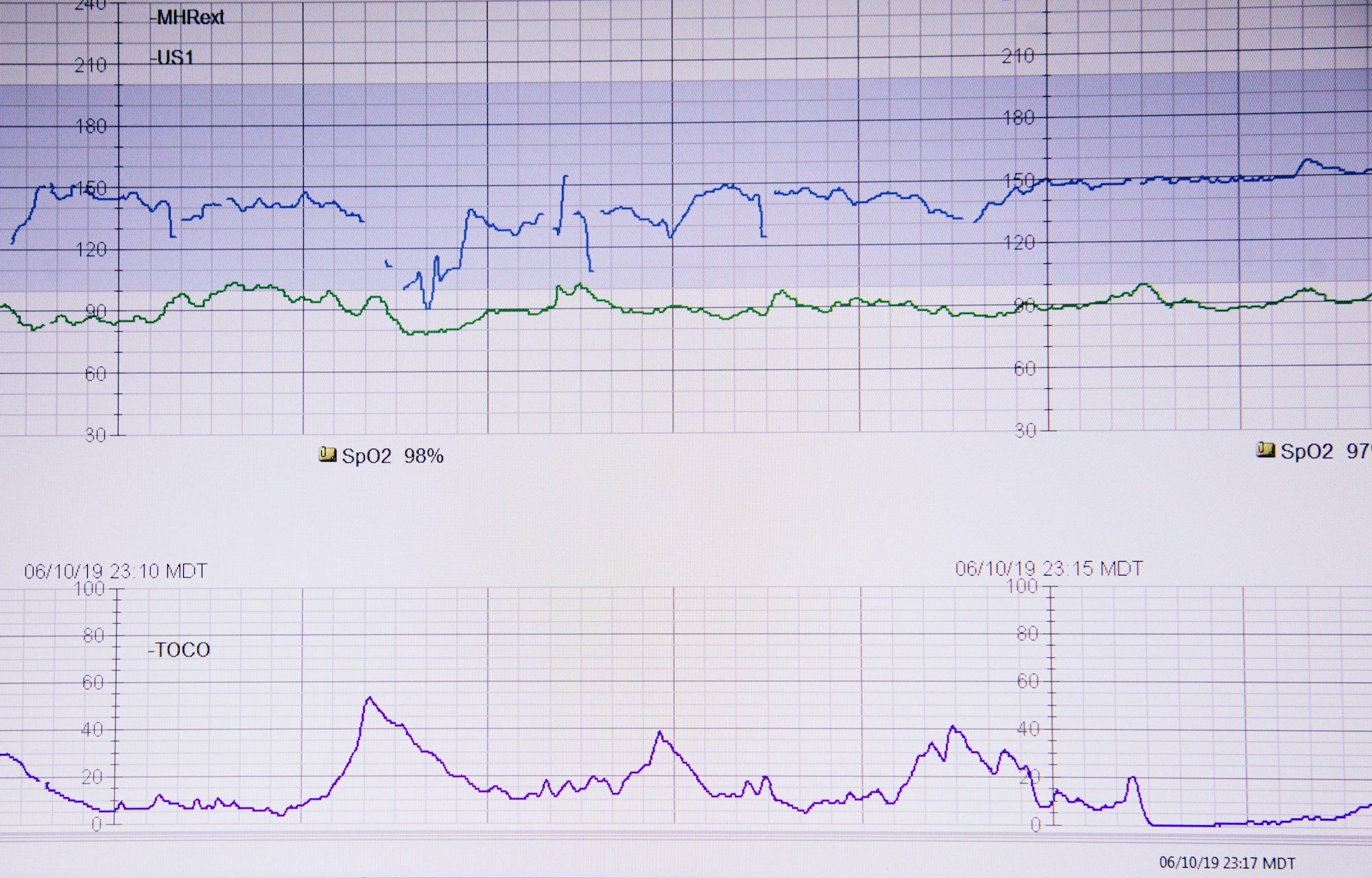A fetal monitoring (CTG) readout tracing the baby's heart rate and the mother's contractions.